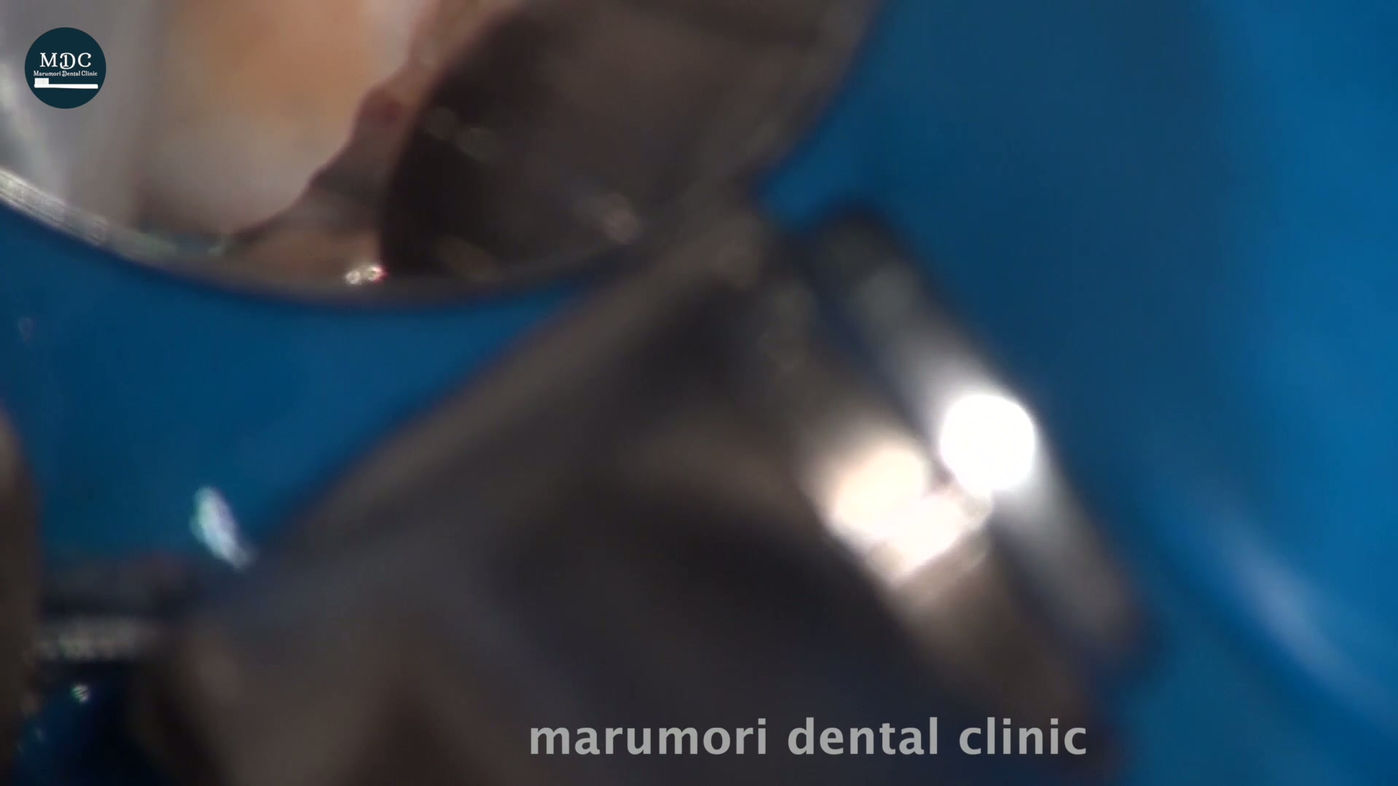 Partial Pulpotomy-2